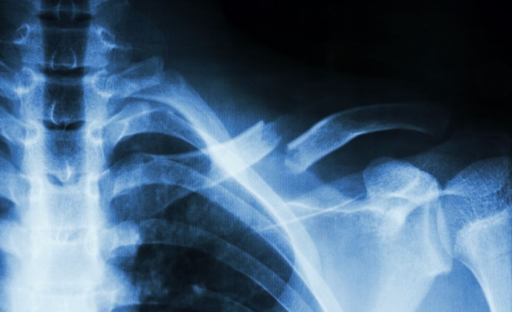Broken Bones Are Serious Motorcycle Accident Injuries